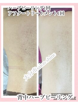 サロンシャイン(Salon Shine)/ハードタイプ ハーブピーリング