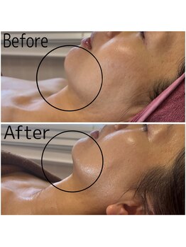 カシェボーテ(CACHE BEAUTE)/カシェの大得意リフトアップ