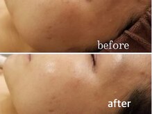 ボヌールデソワ(Bonheur de Soi)/ハーブピーリング