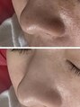 クリアラボ 川崎(Clear Lab) BEFORE/AFTER[毛穴洗浄/毛穴/ハイドラ/毛穴ケア/黒ずみケア]