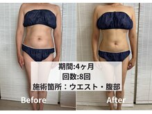 クライオ360(Cryo360)/脂肪冷却ビフォーアフター