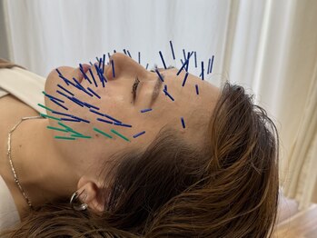 つむぎ鍼灸整骨院の写真/【驚きの小顔に】速攻性◎美容鍼スペシャル100本が人気◎国家資格者による高品質な美容鍼を提供◎