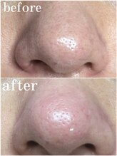 ティーツリー 名古屋 桜山(Tea Tree)/月に１回は毛穴の大掃除