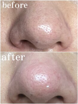 ティーツリー 名古屋 桜山(Tea Tree)/月に１回は毛穴の大掃除