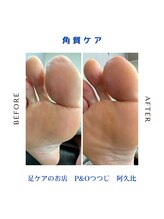ピーアンドオー(P&O)/角質ケア