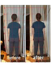 スイレン 西新宿(SUIREN)/施術1回でのbefore/after