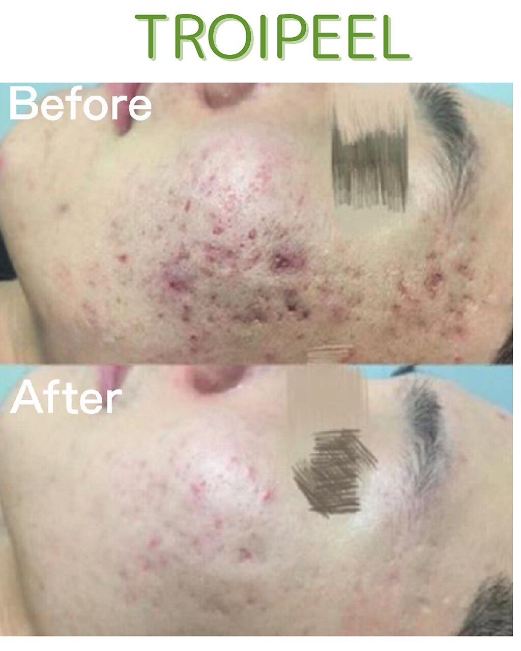 【初めての方】トロイアルケトロイピール25,000円→