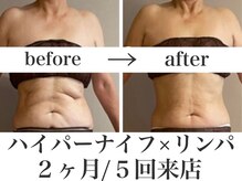 リミー 東大宮店(REME)/【ハイパーナイフ】背中お腹集中