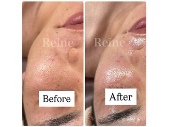 レーヌ(Reine)/白玉ピコジェット