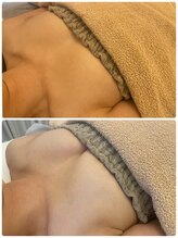 美人バスト 本厚木店/バストアップ◇症例◇