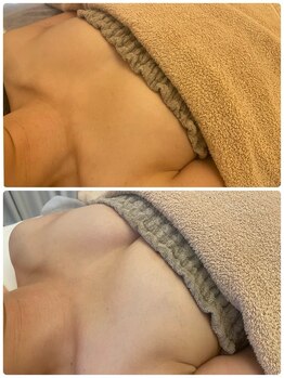 美人バスト 本厚木店/バストアップ◇症例◇