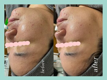 ミウル 天王寺店(miulu)/40代/ハーブピーリング１回