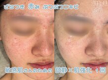 スキンラボアメリ(skin lab. ameri)の雰囲気（トロイアルケ｜ざらつき赤ら顔ニキビケア｜１回でこの変化）