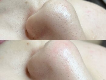 シルクドリバー 大阪店(Silk de River)/ハイドロピーリング