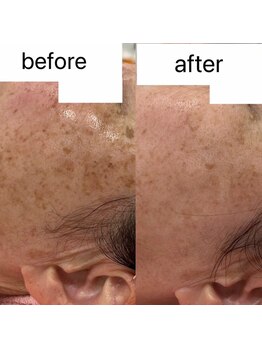 エステサロン ブレス 山形店(BLESS)/フェイシャル結果