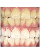 エクラブロウ(ECLAT BROW)/医療提携ホワイトニング