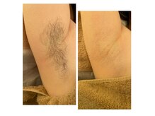 ミックス脱毛がオススメです。痛みも少なくスピード施術