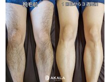 メンズ脱毛サロン アカラ(AKALA)/脚脱毛のビフォーアフター