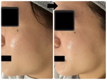 エフェクト 塚口店(effect)/Before After 30代/2回目