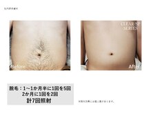 フェレザ 新潟(Felleza)/好きな箇所を集中照射可能