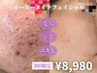 【初回限定】肌解析+オ-ダ-メイド施術+乳酸ピーリング+美容液導入
