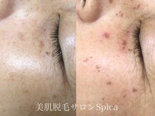 スピカ(SPICA)/シミケア＋BBL