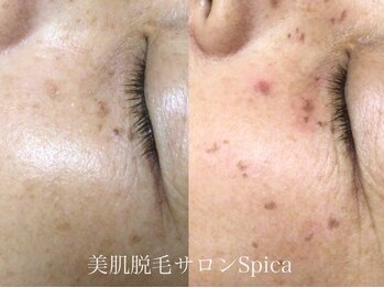 スピカ(SPICA)/シミケア+BBL