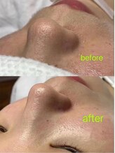 マリヴェリーテ(Mari verite)/毛穴/乾燥/ニキビ/フェイシャル