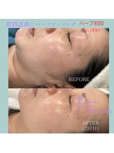 ビューティーサロン セガール(segar)/人気のハーブピーリング