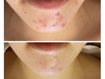 ムム(mumu)の写真/頑固なニキビも毛穴もケア!本格ハーブピーリングで一生モノの素肌へ。