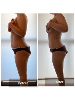 ベルミア(Bellemia)/ダイエットコース