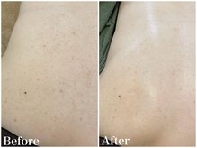 サロンドフェイス(Salon de Faith)/【ハーブピーリング】10回施術♪