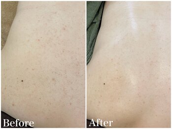 サロンドフェイス(Salon de Faith)/【ハーブピーリング】10回施術♪