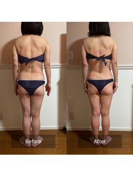 トータル フィルシャイン(Total Fillshine)/全身痩身6回