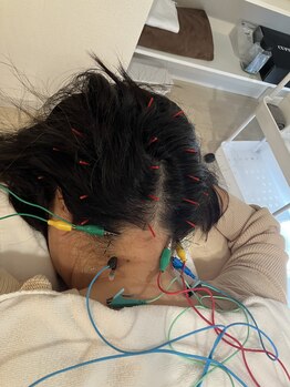 瑞 鍼灸院/頭皮鍼+美容鍼