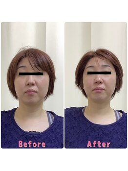 ながれかわ整骨院/SNSで話題のハリネズミ美容鍼