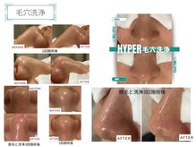 ベルスタイル(Bell style)/当店のお客様症例(毛穴ケア)