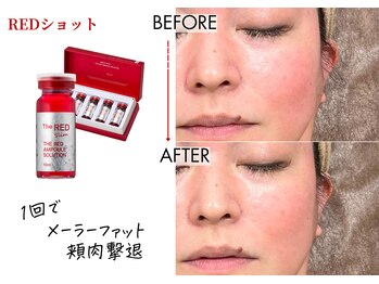キレイベース 銀座店(KIREI BASE)/レッドショット 1回での変化