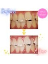 セルフホワイトニングサロン　エクシアホワイトニング　錦糸町店/ホワイトニングビフォーアフター