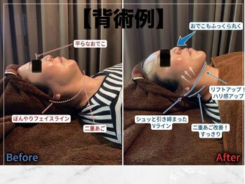 トータルボディケア 整体院ハルヨシ(Total Body Care)/小顔(インモード)