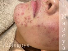 リベル 名古屋(Lebelle:)/ハーブピーリング　名古屋