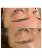 カラフェリズ(Carafeliz)/糸脱毛