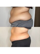 プルメリア(Plumeria)/食事を見直すと効果スピードUP！