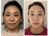 【40歳からの☆たるみケア】小顔矯正で実現☆大人限定☆¥16500→10000