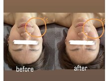 トナリ鍼灸院/気になるほうれい線に●美容鍼