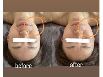 トナリ鍼灸院/気になるほうれい線に●美容鍼