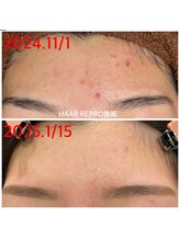 癒 and 美 悠希 ゆうき/HAAB REPLO