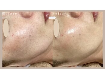 ネリネ(Nerine)/徹底毛穴レスフェイシャル