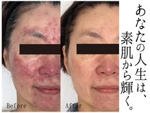 スポット 薬院駅前店(SPOT)/#毛穴洗浄 #黒毛穴 #ニキビケア