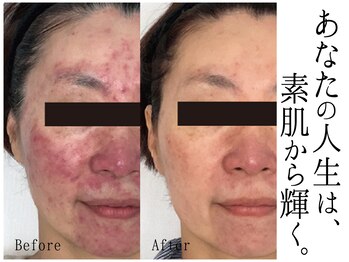 スポット 薬院駅前店(SPOT)/敏感トラブル肌悩みも肌質改善！